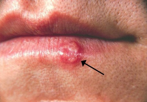 Lippenherpes (Herpes Labialis) an der Unterlippe